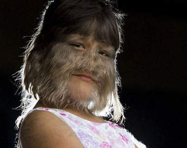 《泰國狼女》全世界毛髮最多的女孩:蘇帕特拉