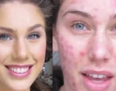 《神奇化妝術》痘花妹變成嫩臉妹～★