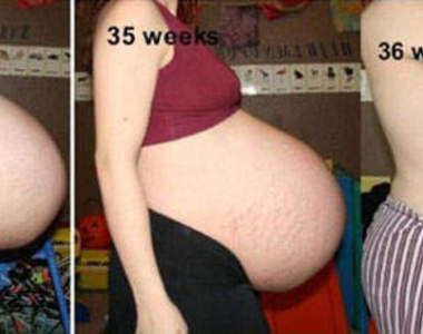 媽媽真的很偉大　三胞胎的懷孕過程