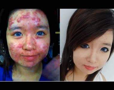 《勇敢痘痘女》超強遮瑕化妝教學