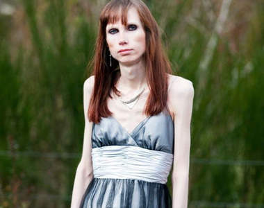 蘇格蘭《激瘦厭食女》她已經餓了20年......