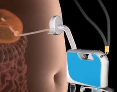 《抽食機》想減肥又吃太多了？那就直接把食物抽掉吧～