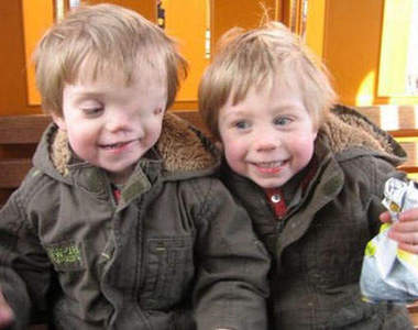 英國《半臉男童》 其實他就跟一般人一模一樣