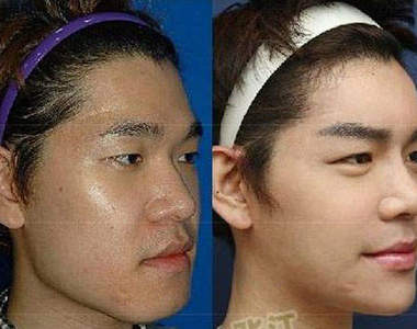 《國字男變V臉男》的整型史 但是削骨看起來超痛......>"<