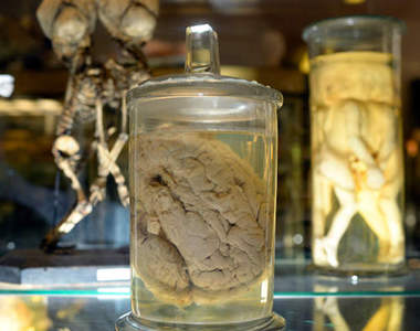 【閱覽絕對注意】法國畸形博物館　超驚悚解剖標本陳列中