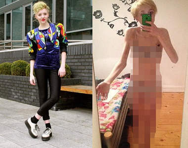 17歲《厭食症少女》得病全因網友一句話.......