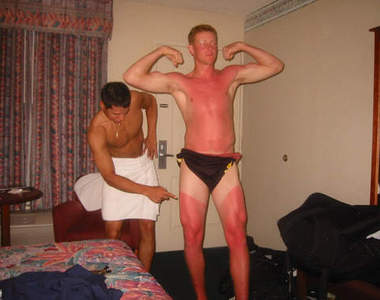 《曬傷照》特輯  忘了擦防曬就會變這樣......