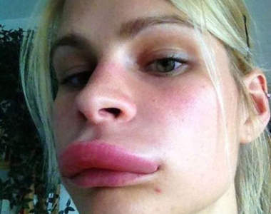 《蚊子豐唇術》人人都能是安潔莉娜裘莉(噘嘴)