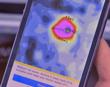 《可偵測皮膚癌的APP》早點發現就能早點治療