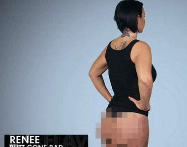 《整形失敗案例》扁扁的屁股可以自己揉到圓...