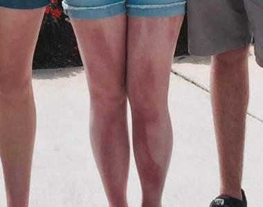 真人分享《防曬沒塗均勻的下場》能曬出虎斑紋也是一絕惹