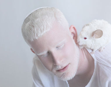 《白化症攝影》純白無瑕的魅力