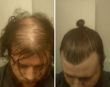 《男性掩飾禿頭的髮型》但其實有禿得更快的危險......