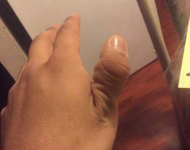 超痛社群流行《拇指脫臼照》盲目跟流行的下場就是痛翻天阿......