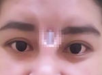 【閱覽注意】《泰女隆鼻後矽膠竟從眉心跑出》直接穿出皮膚看起來好痛阿...... 【閱覽注意】《泰女隆鼻後矽膠竟從眉心跑出》直接穿出皮膚看起來好痛阿......
