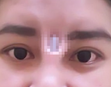 【閱覽注意】《泰女隆鼻後矽膠竟從眉心跑出》直接穿出皮膚看起來好痛阿......