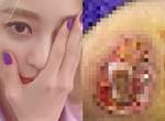 【閱覽注意】女星醫療事故留下《驚悚傷痕》像醫院反應不被理會只好怒公開... 【閱覽注意】女星醫療事故留下《驚悚傷痕》像醫院反應不被理會只好怒公開...