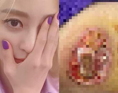 【閱覽注意】女星醫療事故留下《驚悚傷痕》像醫院反應不被理會只好怒公開...