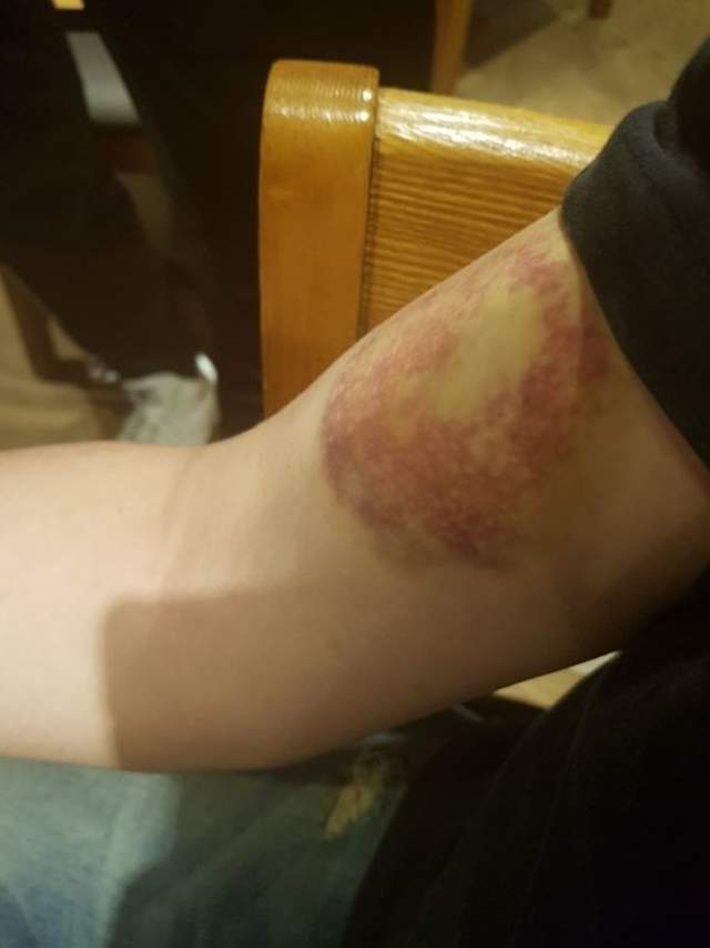 「我被殭屍咬瞭？」...被女友咬一口後 傷口竟越來越嚴重？ 男po網求救：這鮑很毒！(圖)