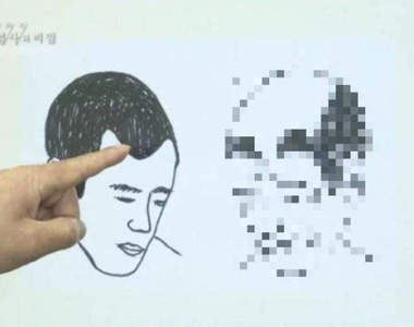 專家提醒：植髮前請謹慎思考《禿頭植髮結果》最後一張圖殺傷力超強