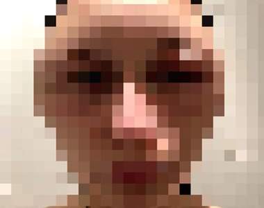 【閱覽注意】19歲少女《染髮劑過敏》讓頭腫一倍大　腫到媽媽都認不出來...