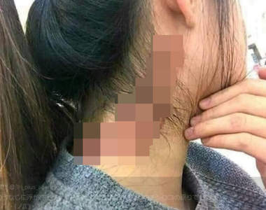 《屌打的痕跡》會不會從小時候就開始擔心這個胎記會變大呢?