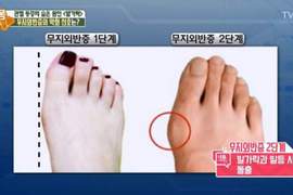 你也有這個困擾嗎《姆指外翻》醫生建議以後少穿這種鞋