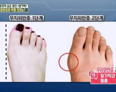 你也有這個困擾嗎《姆指外翻》醫生建議以後少穿這種鞋