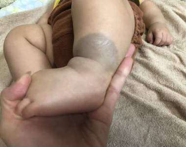 《蒙古斑被誤會小孩遭虐待》一位媽媽的親身體驗引發爸媽們同感...