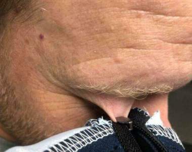 囧事發生的瞬間《當拉鍊夾到了眼皮》我只是想穿件夾克有必要這樣對我嘛QQ