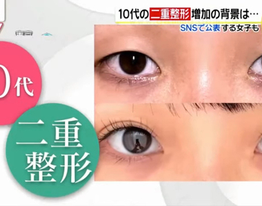 《國中生割雙眼皮議論》父母帶小孩整形爆增 早點解決自卑的外貌究竟好不好?