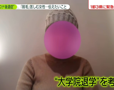 《受新冠肺炎後遺症所苦的人》研究生頭髮狂掉不敢出門見人 害怕畢業之後連工作都找不到