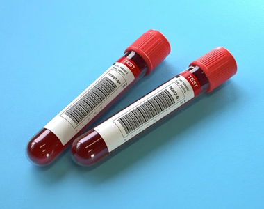 準確率可達九成？AI人工智慧《血液檢測》早期肺癌檢驗登場，提早發現、提早治療！