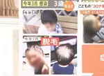 《兒童新冠後遺症》小朋友染疫後也會出現症狀,嚴重甚至還有可能掉髮? 《兒童新冠後遺症》小朋友染疫後也會出現症狀,嚴重甚至還有可能掉髮?