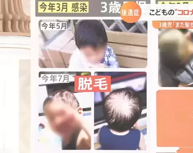《兒童新冠後遺症》小朋友染疫後也會出現症狀,嚴重甚至還有可能掉髮?