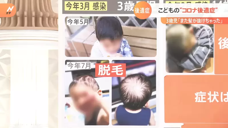 《兒童新冠後遺症》小朋友染疫後也會出現症狀，嚴重甚至還有可能掉髮？