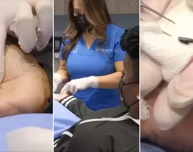 《鉛筆筆芯刺進手掌》女子等了45年才讓醫生動手術把它拿出來