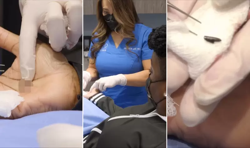 《鉛筆筆芯刺進手掌》女子等了45年才讓醫生動手術把它拿出來 《鉛筆筆芯刺進手掌》女子等了45年才讓醫生動手術把它拿出來