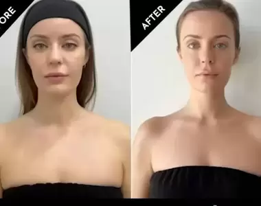 芭比肉毒國外爆紅《barbiebotox》一種新的審美標準正在網路上蔓延開來