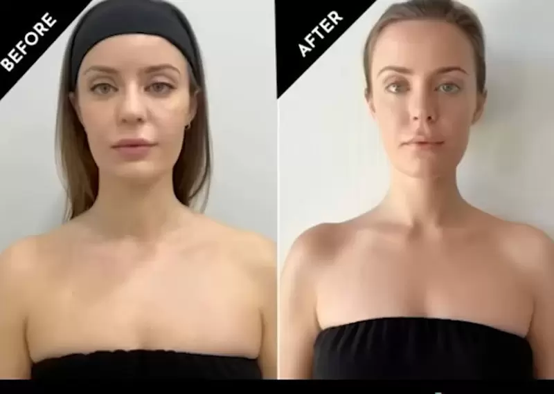 芭比肉毒國外爆紅《barbiebotox》一種新的審美標準正在網路上蔓延開來 芭比肉毒國外爆紅《barbiebotox》一種新的審美標準正在網路上蔓延開來