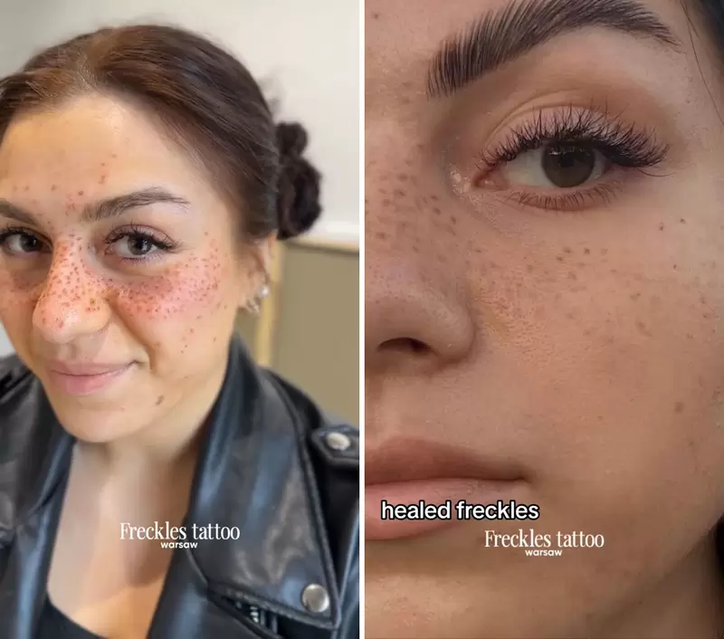 《刺青雀斑風潮》國外女生跟風引起熱議，刺青師表示過陣子會淡化，請大家冷靜一點