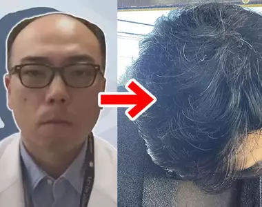 《禿頭醫生大變身》新冠疫情期間推廣疫苗被罵爆 拿勝訴賠償金生髮變得超濃密