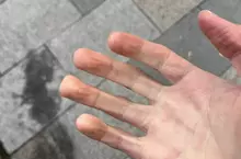 《手指變方形的人》天氣冷就會發生這種現象？有這種身體的人算是極少數？