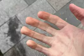 《手指變方形的人》天氣冷就會發生這種現象?有這種身體的人算是極少數? 《手指變方形的人》天氣冷就會發生這種現象?有這種身體的人算是極少數?