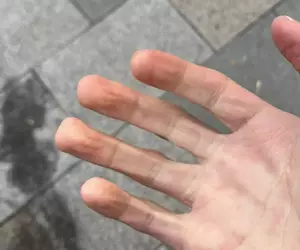 《手指變方形的人》天氣冷就會發生這種現象？有這種身體的人算是極少數？