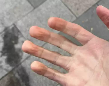 《手指變方形的人》天氣冷就會發生這種現象?有這種身體的人算是極少數?