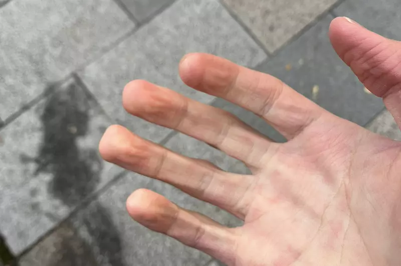 《手指變方形的人》天氣冷就會發生這種現象?有這種身體的人算是極少數? 《手指變方形的人》天氣冷就會發生這種現象?有這種身體的人算是極少數?